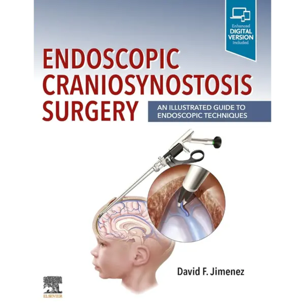 Endoscopic Craniosynostosis Surg Endoscopic Craniosynostosis Surgery: An Illustrated Guide to Endoscopic Techniques